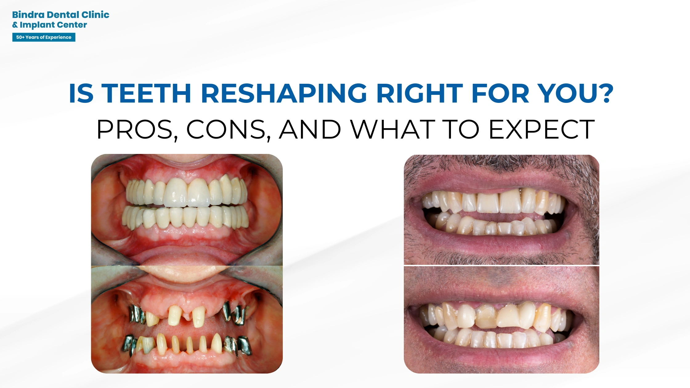 Teeth Reshaping