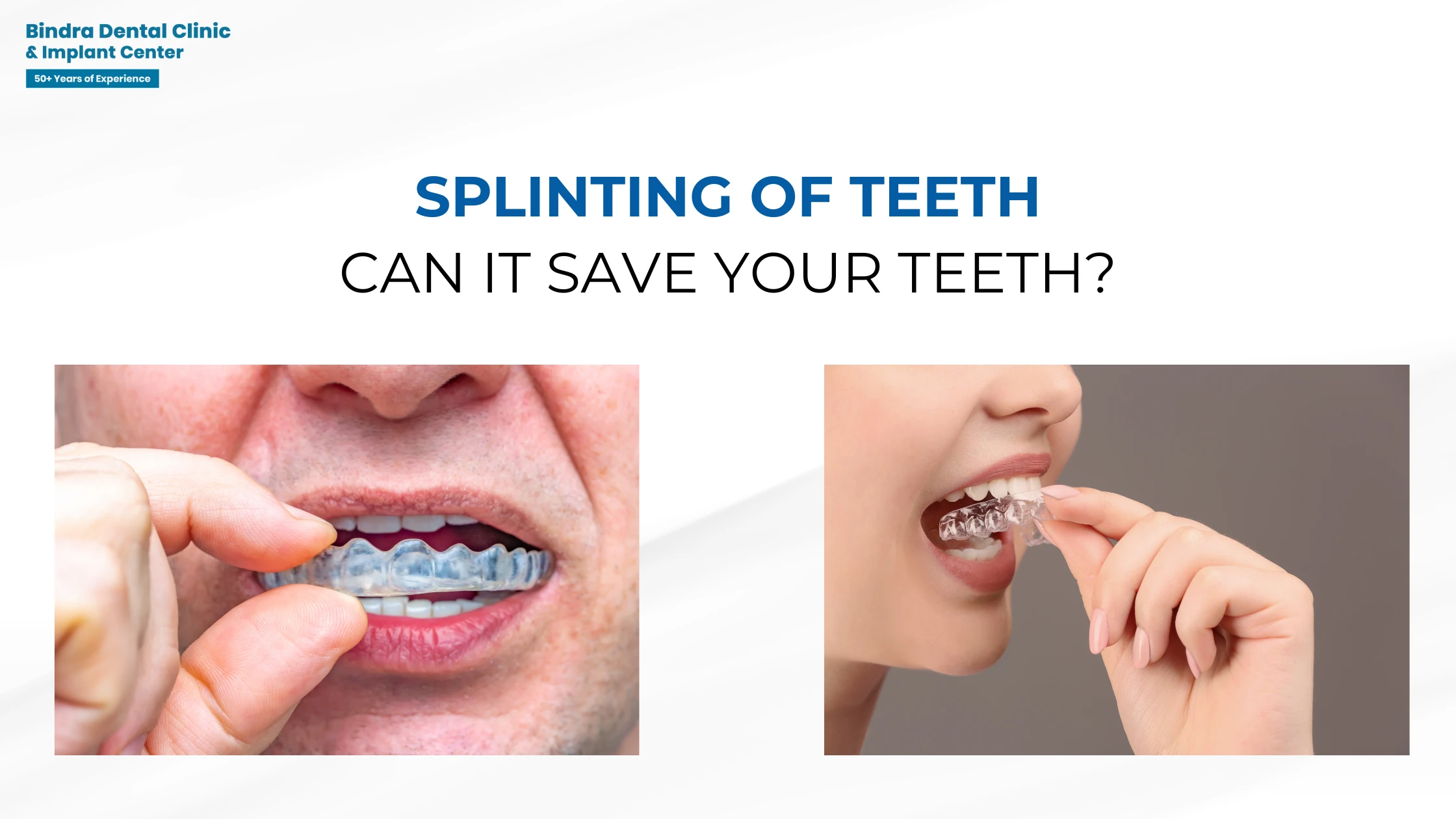 Splinting of Teeth